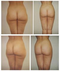 liposuzione prima dopo