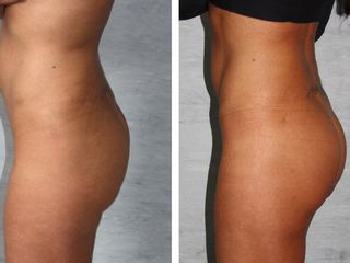 liposcultura prima dopo