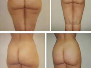 liposcultura prima dopo