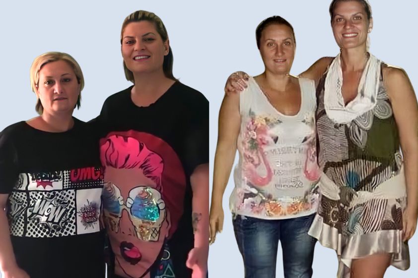 Riduzione stomaco prima e dopo - 823066