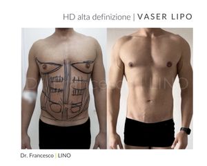 Liposuzione - Dott. Francesco Lino