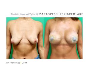 Mastopessi - Dott. Francesco Lino
