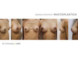 Mastoplastica additiva - Dott. Francesco Lino