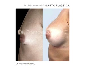 Mastoplastica additiva - Dott. Francesco Lino