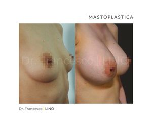 Mastoplastica additiva - Dott. Francesco Lino