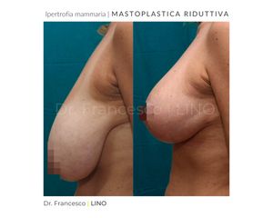 Mastoplastica riduttiva - Dott. Francesco Lino