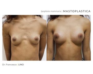 Mastoplastica additiva - Dott. Francesco Lino