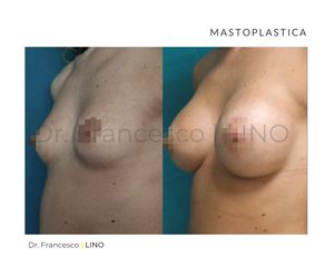 Mastoplastica additiva - Dott. Francesco Lino