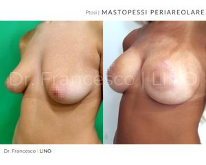 Mastopessi - Dott. Francesco Lino