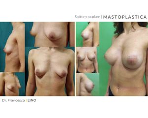Mastoplastica additiva - Dott. Francesco Lino