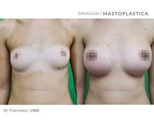Mastoplastica additiva - Dott. Francesco Lino