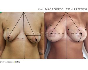 Mastopessi - Dott. Francesco Lino