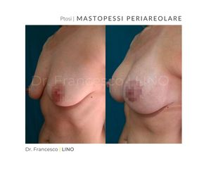 Mastopessi - Dott. Francesco Lino