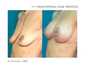 Mastopessi - Dott. Francesco Lino