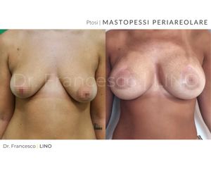 Mastopessi - Dott. Francesco Lino