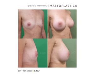 Mastoplastica additiva - Dott. Francesco Lino