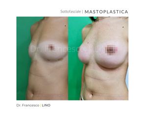 Mastoplastica additiva - Dott. Francesco Lino