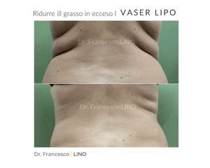 Liposuzione - Dott. Francesco Lino