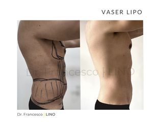 Liposuzione - Dott. Francesco Lino