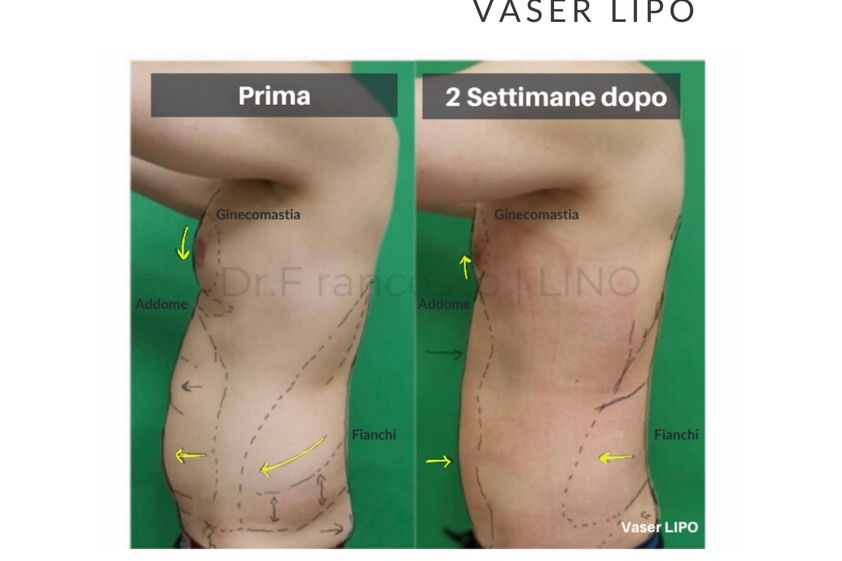 Lipo Vaser prima e dopo - 773189