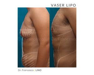 Liposuzione - Dott. Francesco Lino