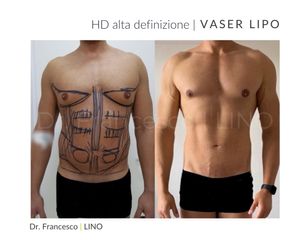 Liposuzione - Dott. Francesco Lino