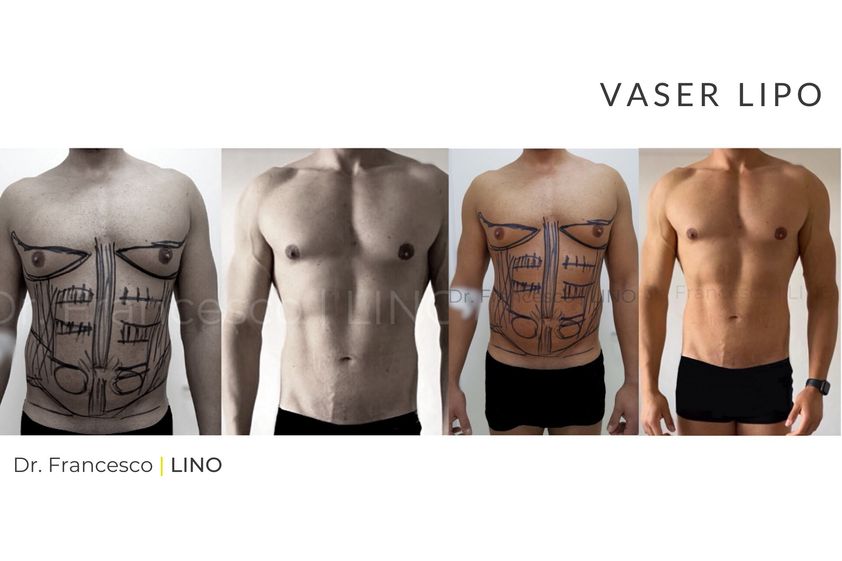 Lipo Vaser prima e dopo - 773194
