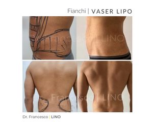 Liposuzione - Dott. Francesco Lino