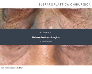 Blefaroplastica - Dott. Francesco Lino