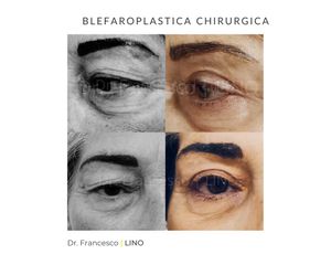 Blefaroplastica - Dott. Francesco Lino