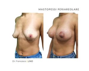 Mastopessi - Dott.ssa Stefania Cocchi
