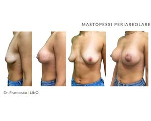 Mastopessi - Dott.ssa Stefania Cocchi