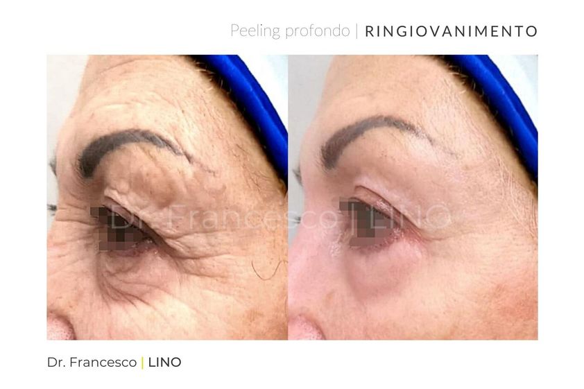 Peeling chimico prima e dopo - 774907