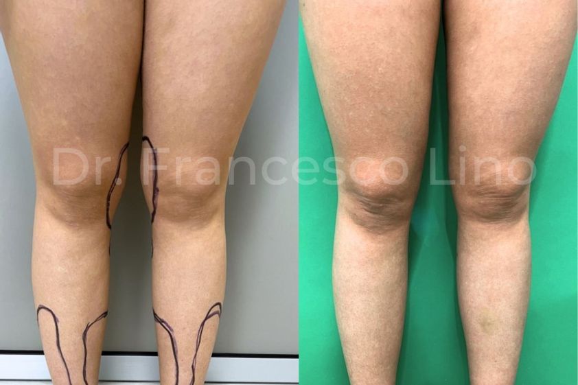 Lipo Vaser prima e dopo - 869894