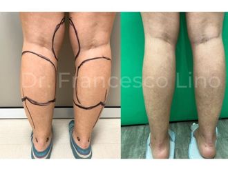 Lipo Vaser - 869895