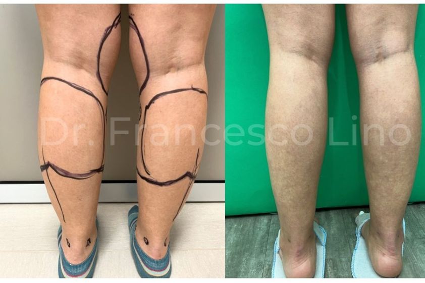 Lipo Vaser prima e dopo - 869895