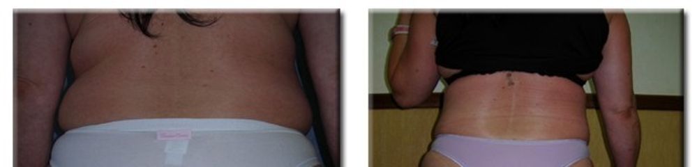 Liposcultura prima e dopo