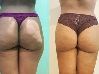 Liposcultura classica prima dopo
