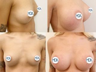 Mastoplastica additiva prima e dopo