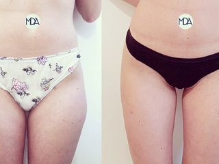 Lipo laser prima dopo