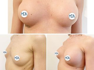 Mastoplastica additiva prima e dopo