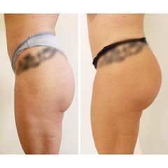 Dott. Matteo D'Ambrosio aumento glutei con acido ialuronico