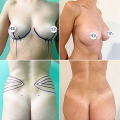 Dott. Matteo D'Ambrosio Mastoplastica additiva e liposuzione fianchi