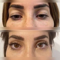 Dott. Matteo D'ambrosio Blefaroplastica Prima e Dopo