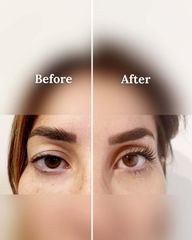 Dott. Matteo D'Ambrosio Blefaroplastica prima e dopo