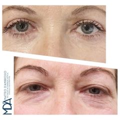 Dott. Matteo D'Ambrosio Blefaroplastica