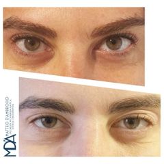 Dott. Matteo D'Ambrosio Blefaroplastica