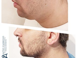 Liposuzione prima e dopo - 878340