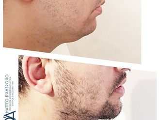 Liposuzione prima e dopo - 878341