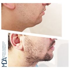 Dott. Matteo D'Ambrosio Lifting Viso